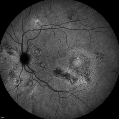Angiografia con verde di indocianina in CSC