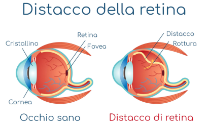 distacco_retina