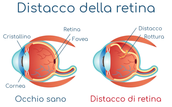 distacco_retina