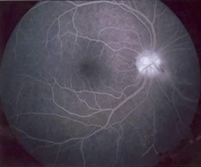 Retina durante gli effetti di una Fluorangiografia